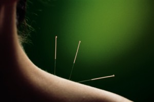 acupuncture 2